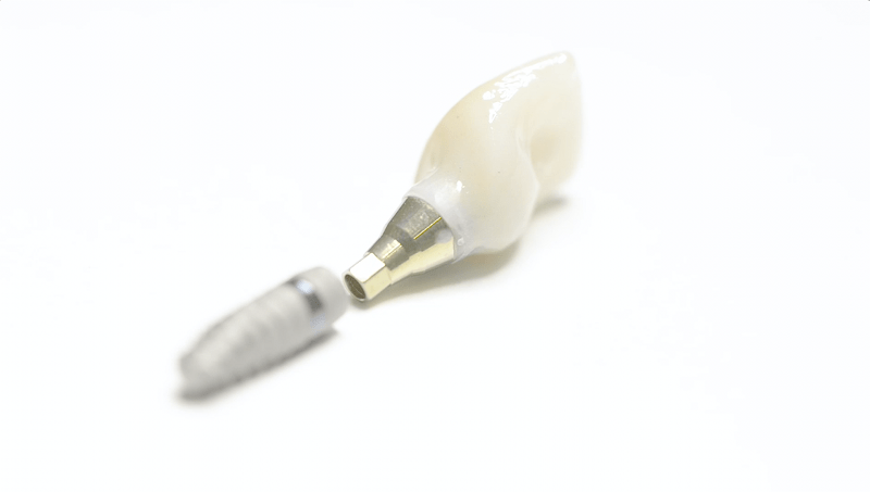protesis dental