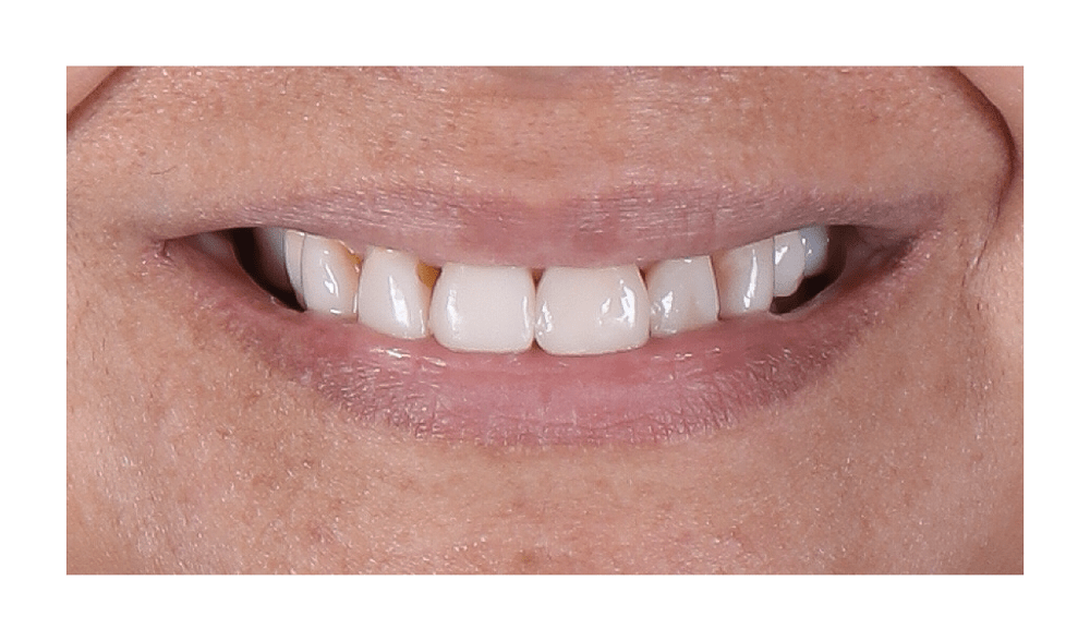 resultado estetica dental