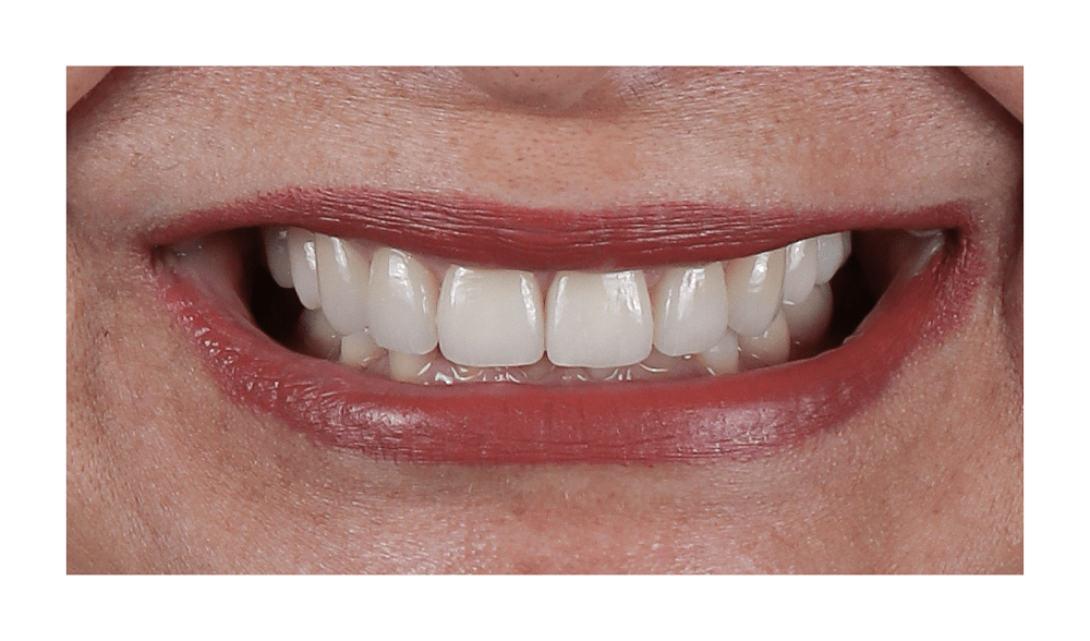resultado tratamiento estetica dental